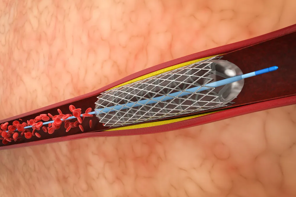 Angioplastia coronaria en CDMX: tratamiento intervencionista de arterias obstruidas